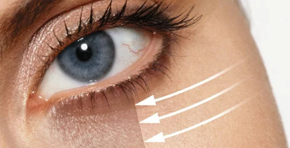 Treatment of dark circles under eyes